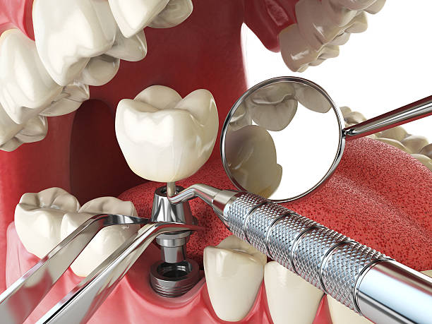 Best Emergency Wisdom Teeth Removal in Park Hills, MO